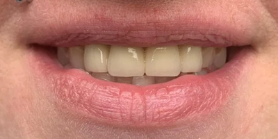 smile2-after