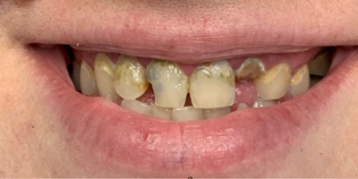 smile2-before
