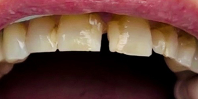 smile3-before