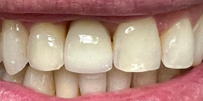 smile4-after