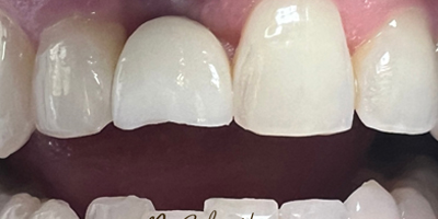 smile4-before
