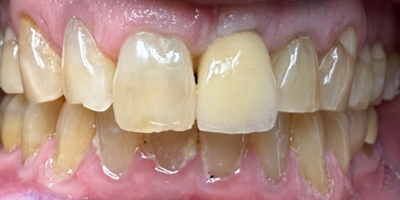 smile5-after