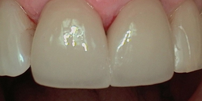 smile6-after