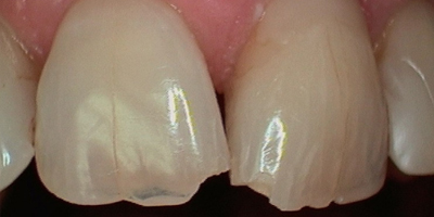 smile6-before